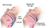 Ai dễ mắc chứng ngưng thở khi ngủ, cách xử trí đúng