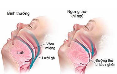 https://umcclinic.com.vn/Data/Sites/1/media/y-hoc-thuong-thuc/ngay-to-vo-lo-hay-phai-dang-lo-ve-chung-ngung-tho-khi-ngu.jpg