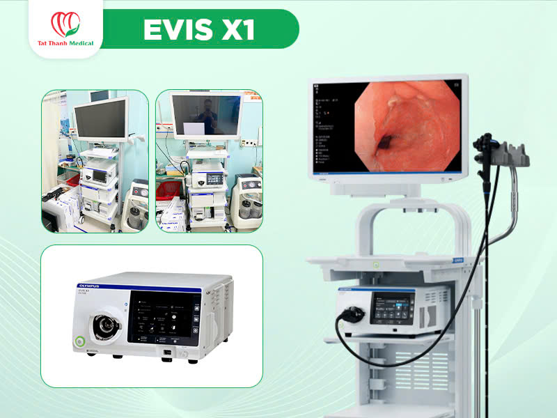 Olympus nâng tầm chuẩn chẩn đoán với hệ thống nội soi tiêu hóa CV-170, CV-190 và EVIS X1