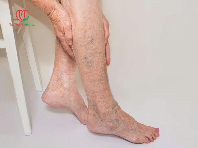 chân của người bị suy tĩnh mạch